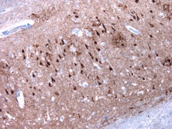 hippocampe-Alzheimer-degenerescences-neurofibrillaires